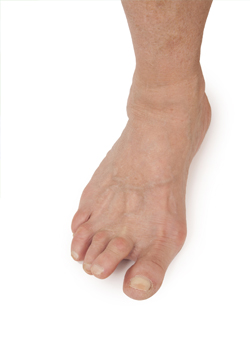 rheumatoid arthritis foot